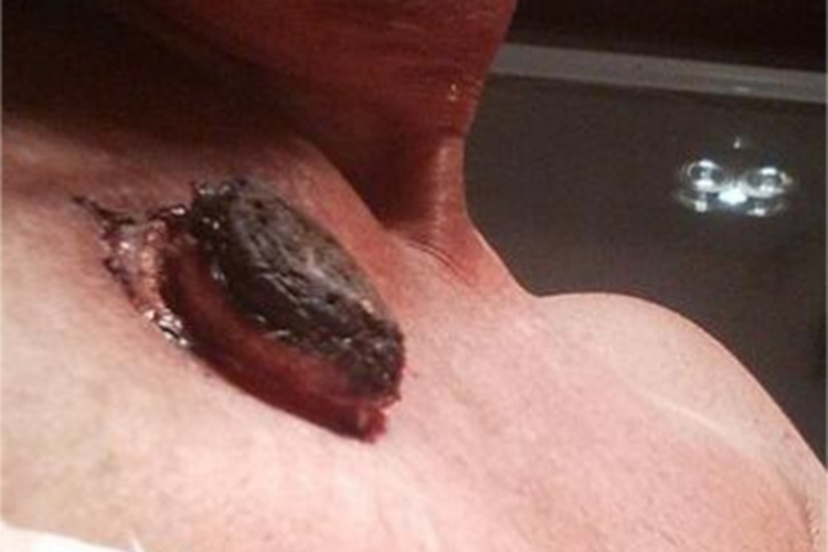 皮肤基底细胞癌胸部结痂图