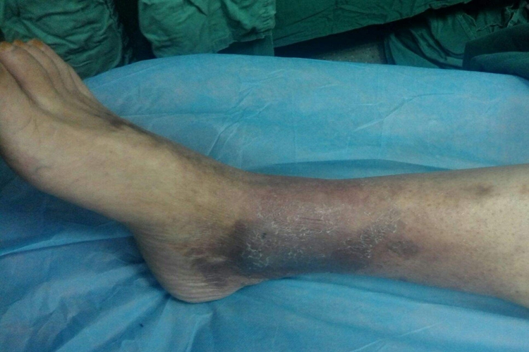 深静脉血栓图 深静脉血栓图