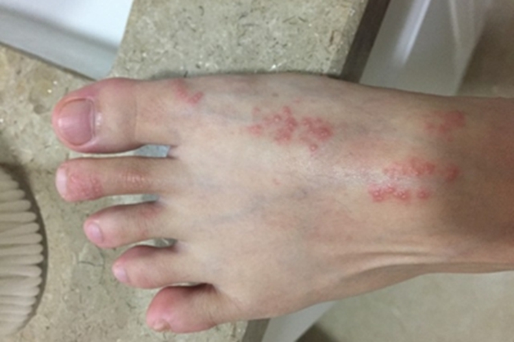 湿疹样紫癜脚背疙瘩图 湿疹样紫癜脚背疙瘩图