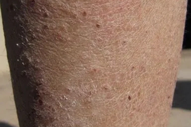 皲裂性湿疹小腿粗糙裂纹深图