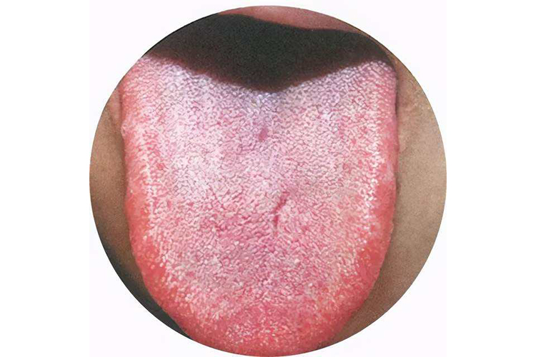 气郁体质舌苔图