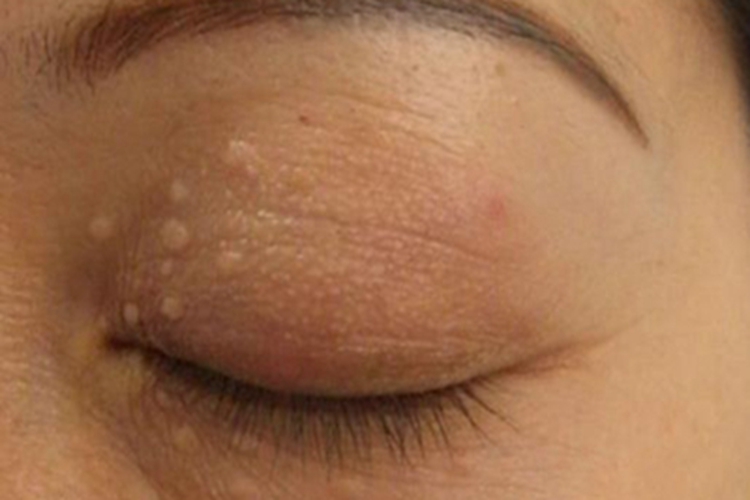 汗腺瘤上眼睑白色小疙瘩图