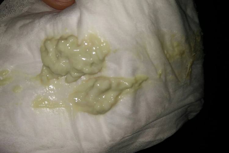 念珠菌性阴道炎分泌物图