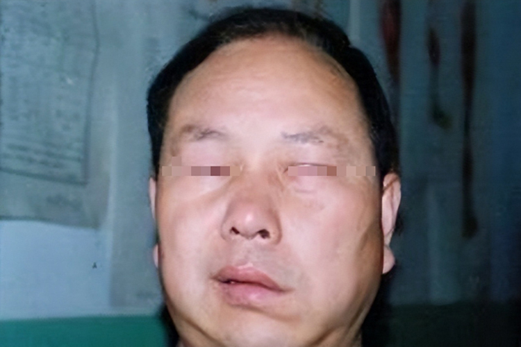 脑梗致面瘫后遗症图 脑梗致面瘫后遗症图