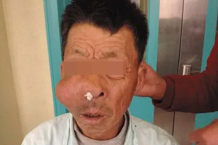 晚期上颌窦癌面部症状图