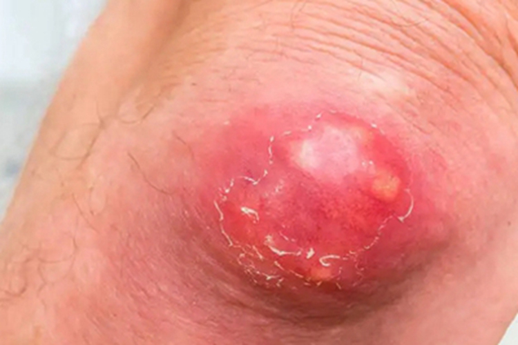 皮脂腺癌肘部囊肿图