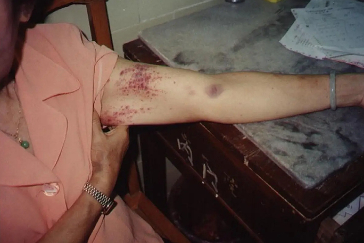 特发性血小板减少性紫癜图