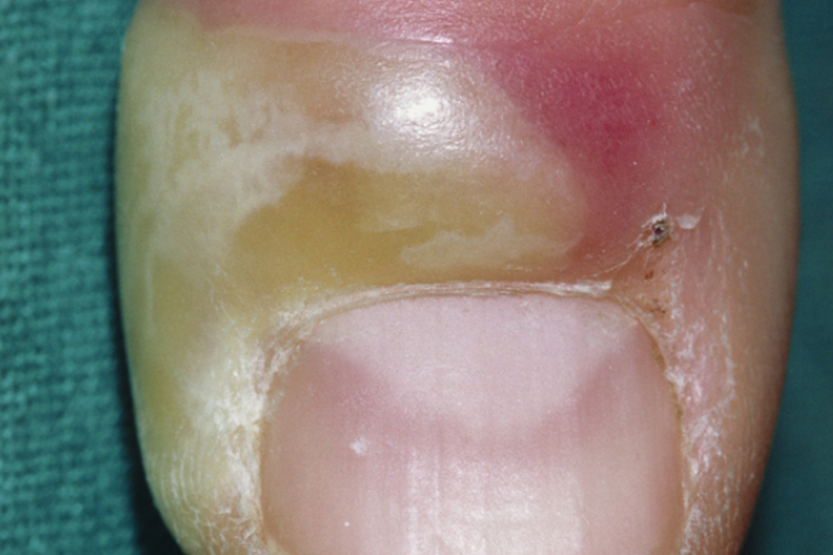 急性甲沟炎化脓图