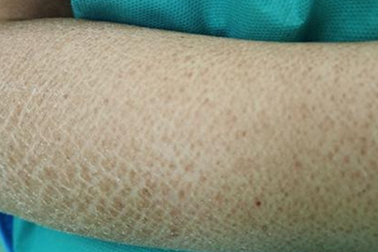 无汗症皮肤粗糙图 无汗症皮肤粗糙图