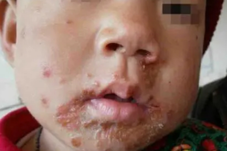 口腔疱疹口周结痂图