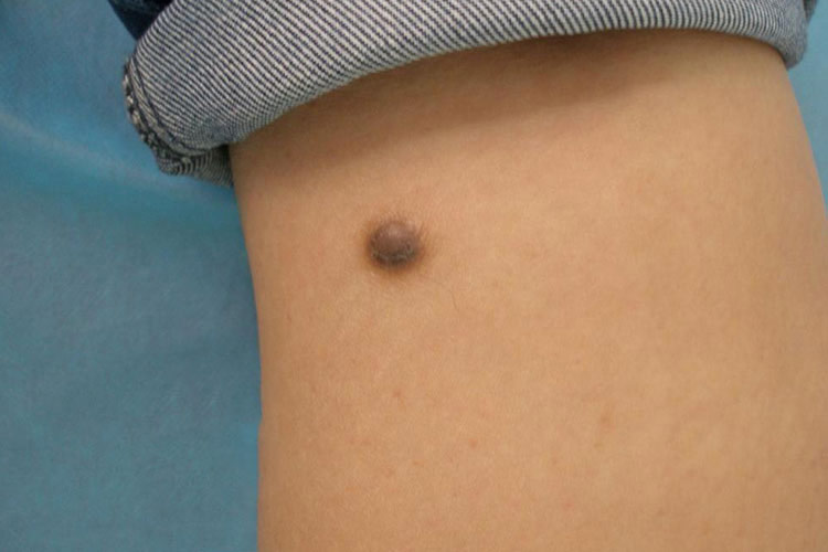 黑褐色皮肤纤维瘤图