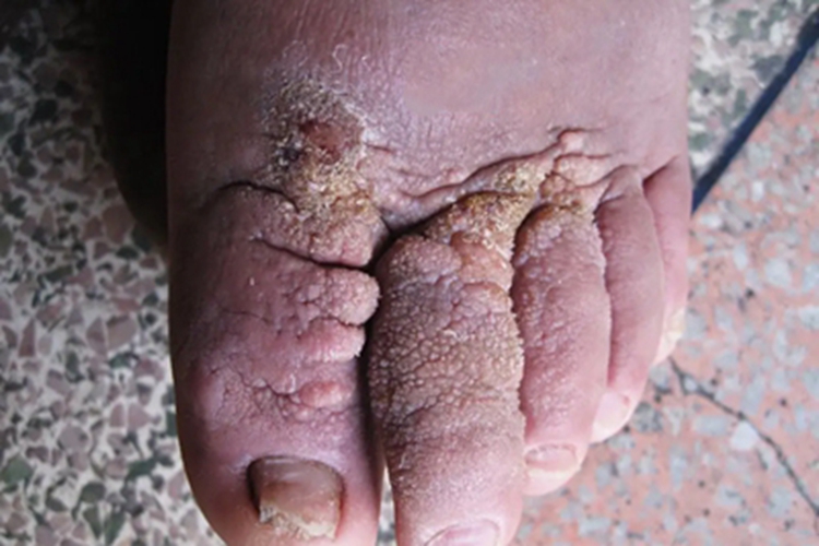 淋巴水肿皮肤粗糙图