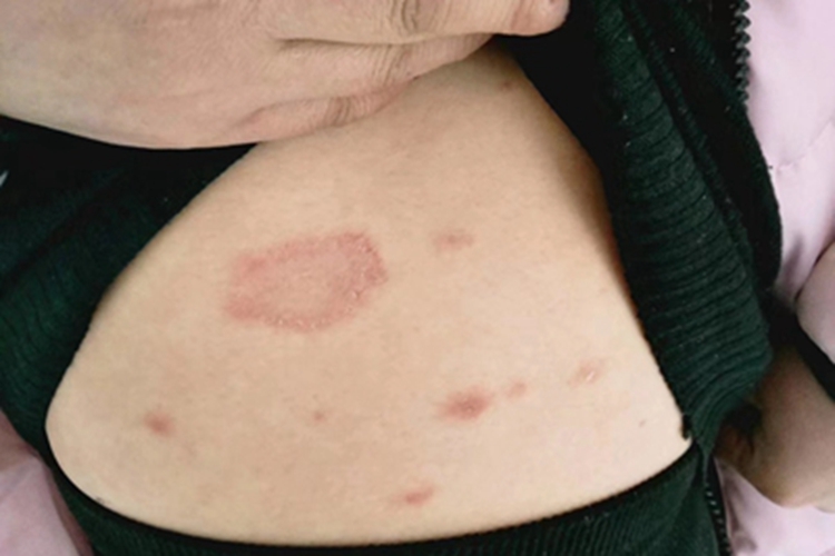 玫瑰糠疹腹部脱屑图