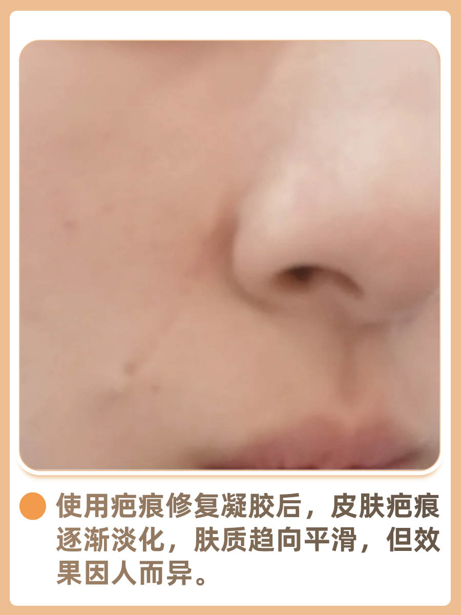 分享！疤痕修复凝胶效果怎么样？