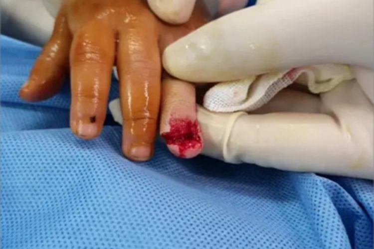 夹伤手指缺损图