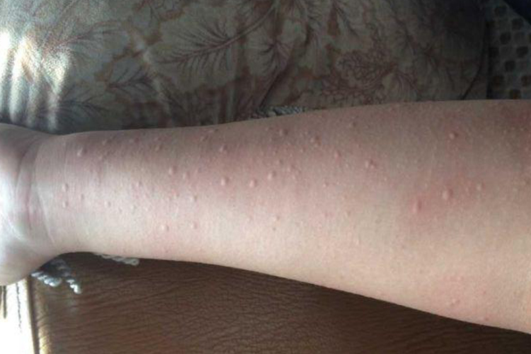 手臂胆碱能荨麻疹图 手臂胆碱能荨麻疹图