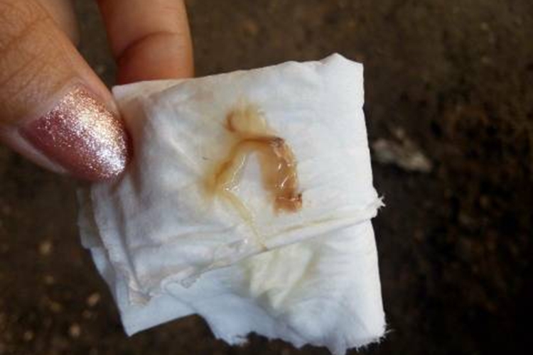 宫颈炎褐色分泌物图