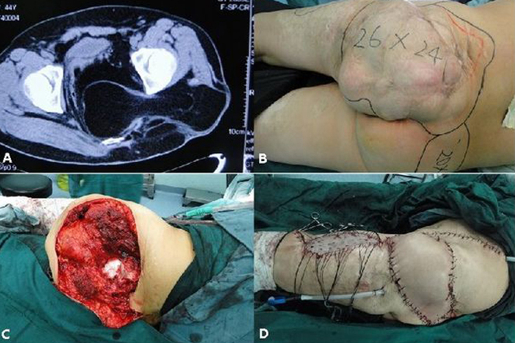 臀部脂肪肉瘤 臀部脂肪肉瘤