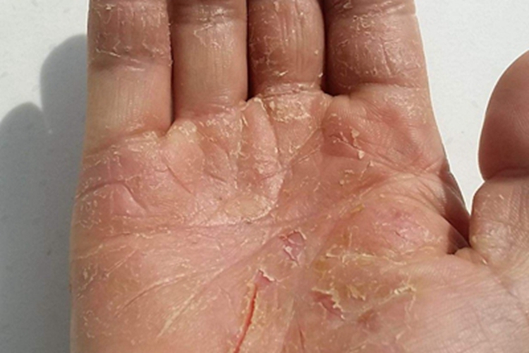 皲裂性湿疹手掌脱屑有裂口图