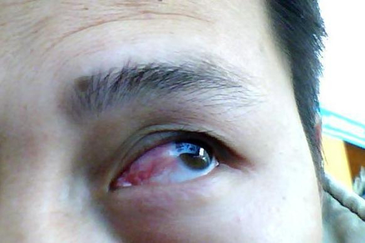 严重眼睑裂斑图