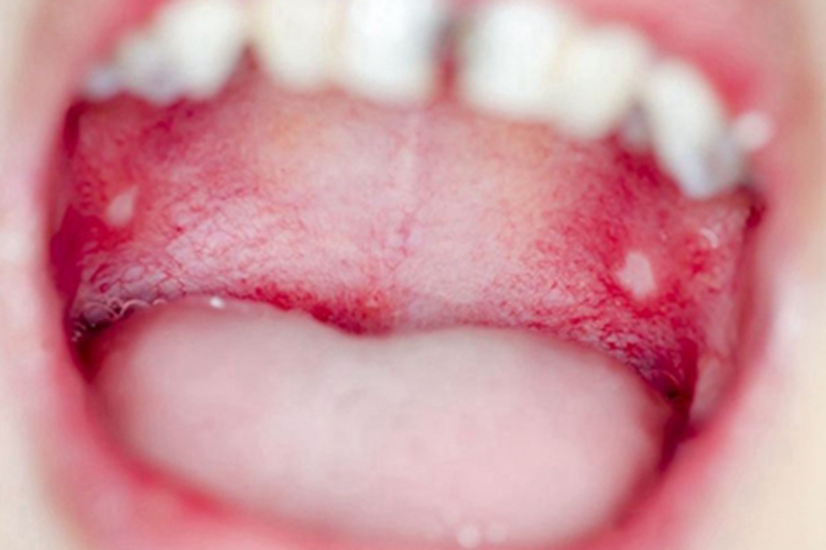 过敏性接触性口炎口腔症状图 过敏性接触性口炎口腔症状图