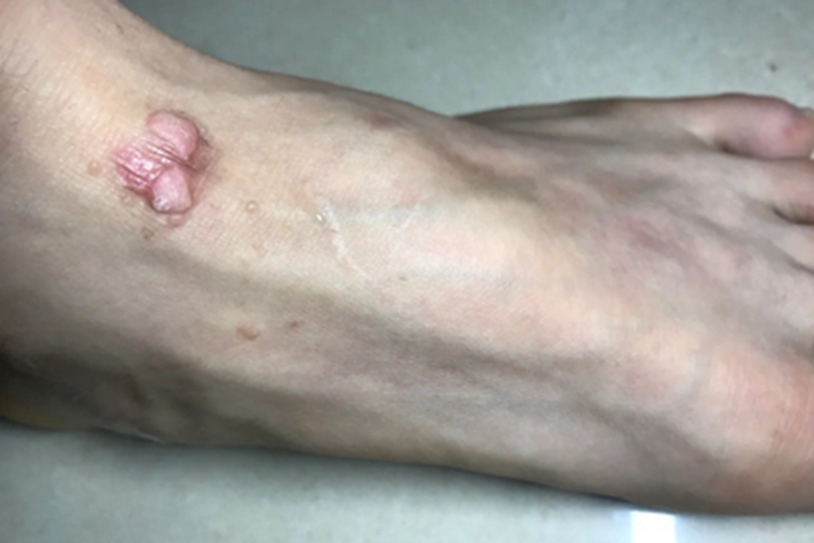 皮肤平滑肌瘤脚背症状图 皮肤平滑肌瘤脚背症状图