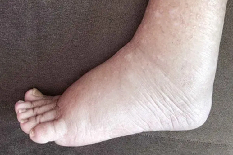 特发性水肿脚部皮肤粗糙图