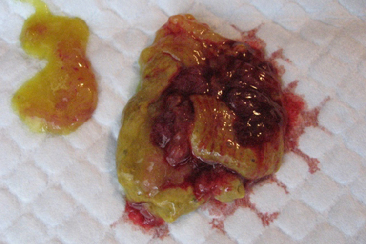 直肠癌便血暗红色图 直肠癌便血暗红色图