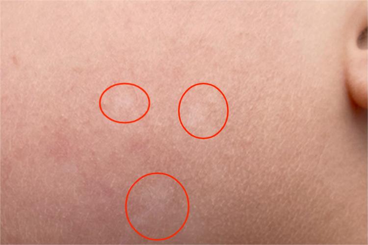 白色糠疹面部斑图