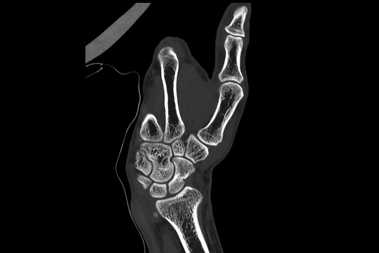 手部CT大拇指图