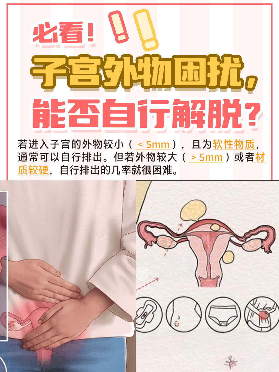 必看！子宫外物困扰，能否自行解脱？