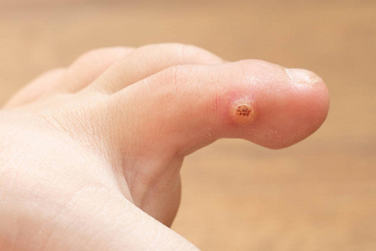 脚趾缝跖疣图 脚趾缝跖疣图