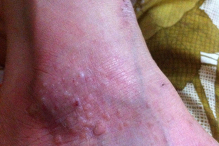 金黄色苔藓症状图