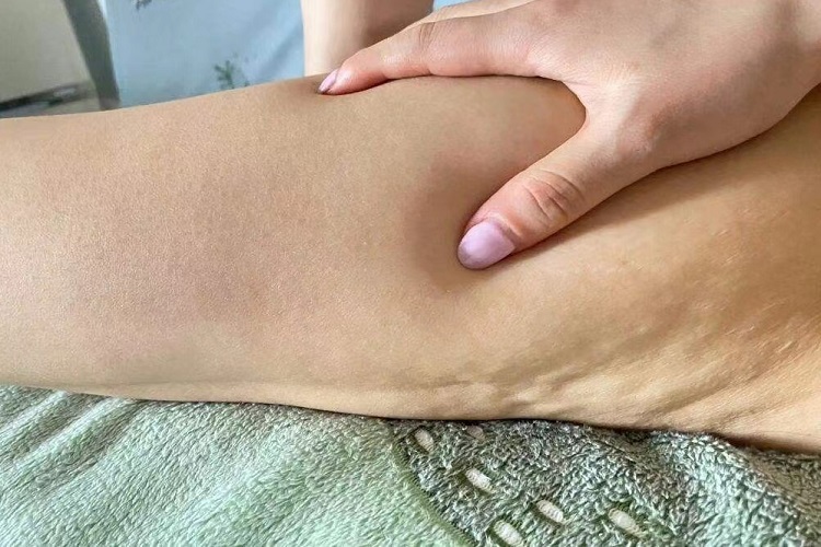 进行性脂肪营养不良大腿松弛图