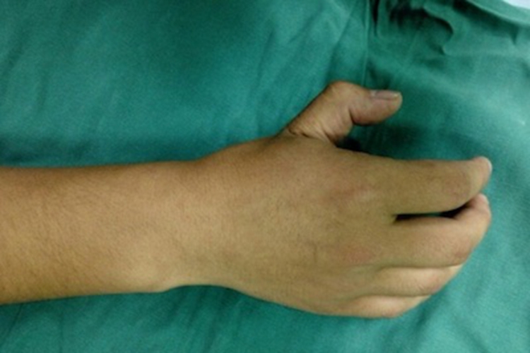 掌指关节脱位手指变形图 掌指关节脱位手指变形图