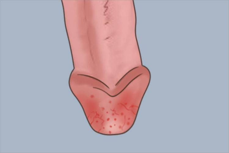 急性浅表性包皮龟头炎红肿手绘图