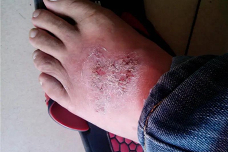 湿疹脚背脱屑图 湿疹脚背脱屑图