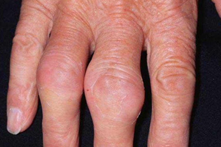 痛风手指红肿有大包图