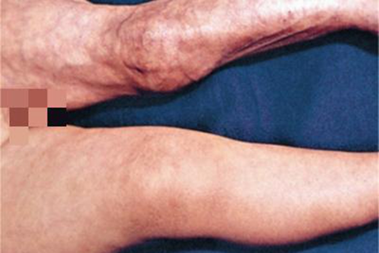 萎缩性慢性肢端皮炎症状图