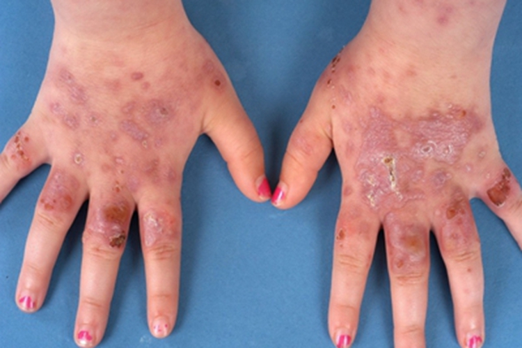 种痘样水疱病手背症状图