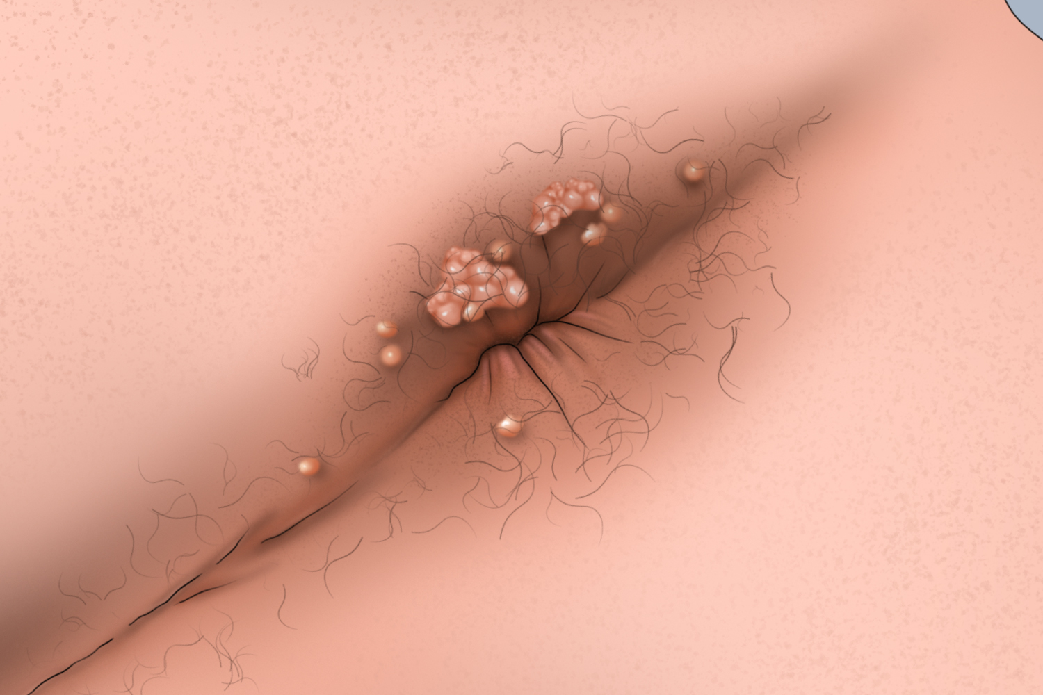 男性外阴尖锐湿疣肛周症状手绘图