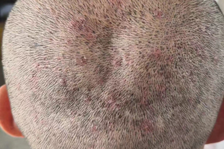 毛囊炎头皮症状图 毛囊炎头皮症状图