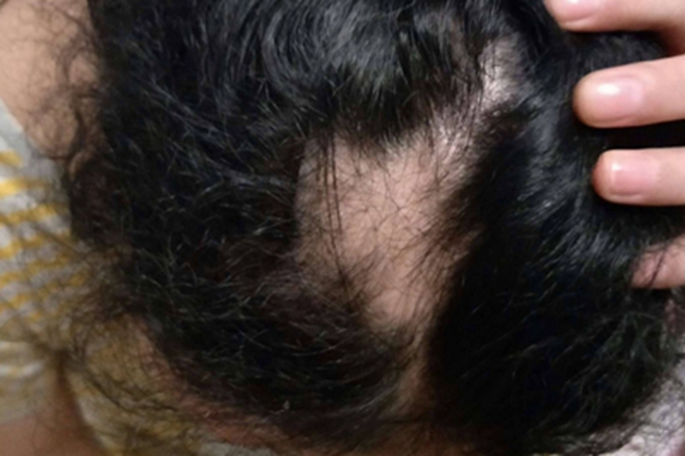 系统性红斑狼疮头皮脱发图