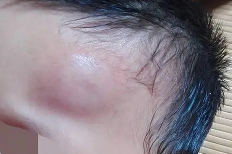 小孩额头皮下血肿图