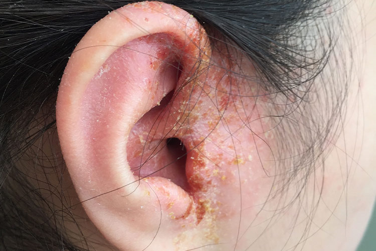 耳部急性湿疹图片