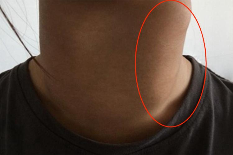 甲状腺囊肿侧颈包块图 甲状腺囊肿侧颈包块图