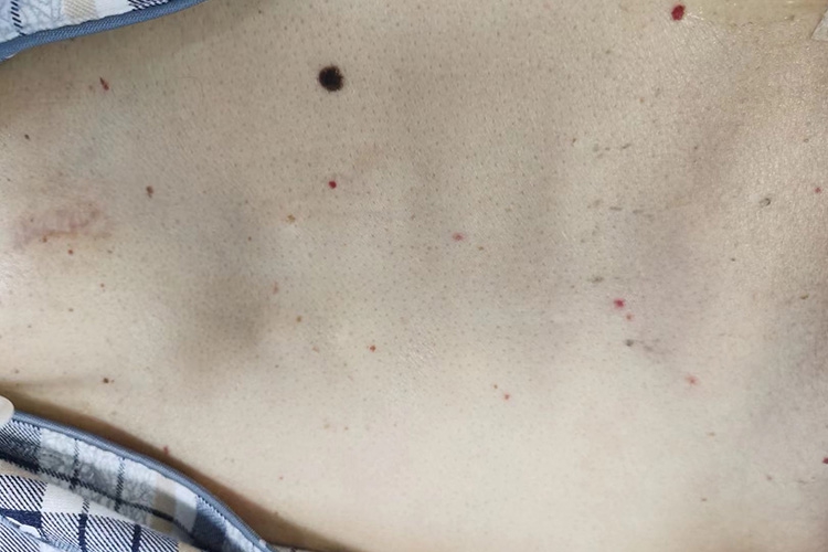 胸部红痣图 胸部红痣图