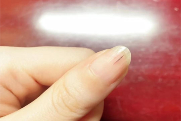 指甲裂片形出血血丝图