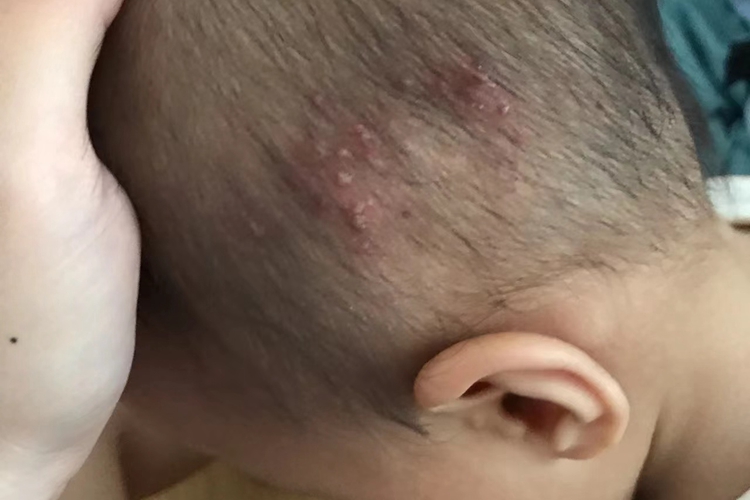 头皮脓痱图 头皮脓痱图