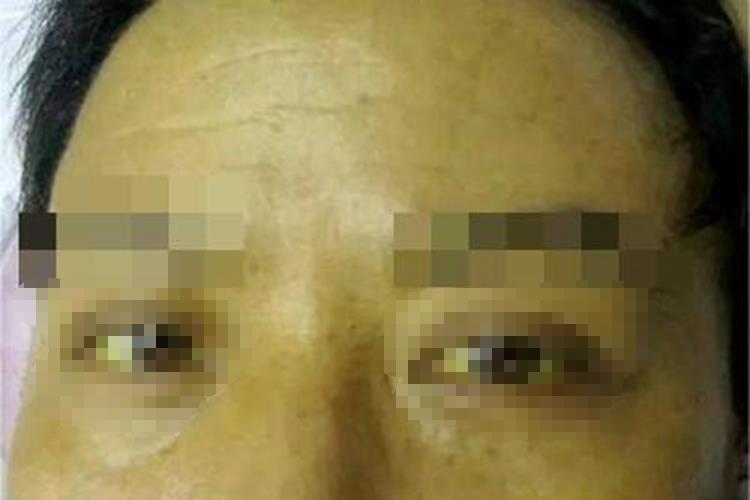 胆汁淤积性黄疸面部皮肤发黄图